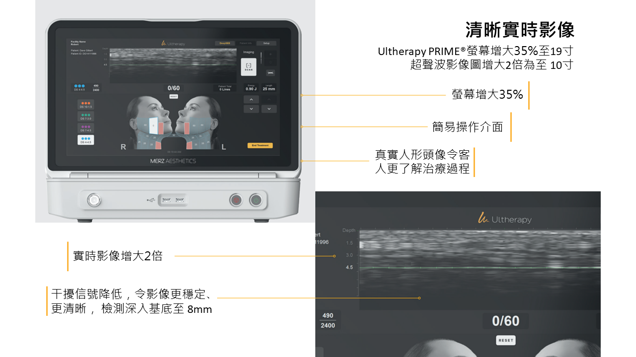 Ultherapy PRIME points